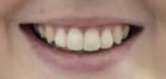 Adult braces
