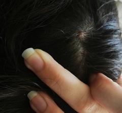 Small lumps on scalp