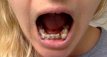 Adult braces