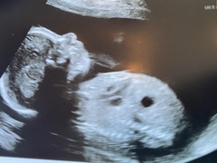 Pregnancy after loss - Autumn Babies 2021 - Thread 3