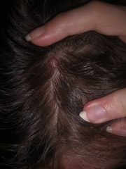 Small lumps on scalp