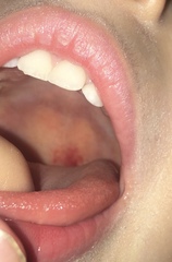 Any idea what these are sore spots inside mouth