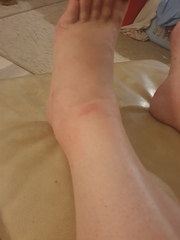 Mosquito bite and allergic reactions