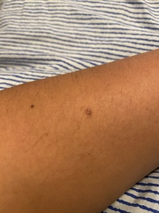 Weird new mole