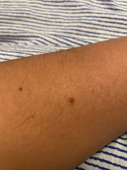 Weird new mole