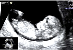 Baby Gender