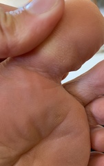 What is this on my foot? (Trigger warning, not the nicest picture of a possible bite on my big toe!)