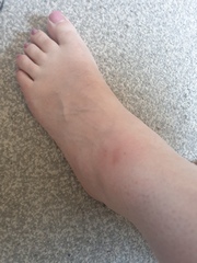 Mosquito bite and allergic reactions