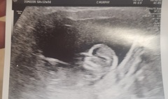 12 week scan - gender guess?