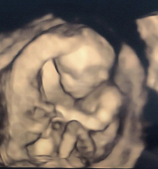 Nasal bone visible? Opinions appreciated!!