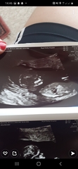 Baby scan 12 week