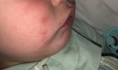 Toddler & constant cheek rash