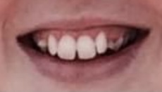 Adult braces