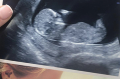 Nasal bone visible? Opinions appreciated!!