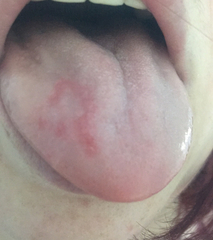 Any idea what these are sore spots inside mouth