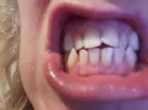 I know first world problems but- teeth bleaching trays-aargh!