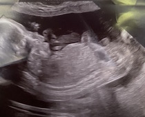 Anyone else have a 20 week scan like this??