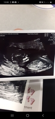 Baby scan boy or girl