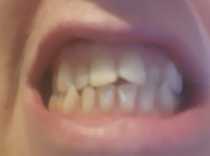 I know first world problems but- teeth bleaching trays-aargh!