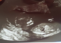 Boy or girl? Scan pic opinions please!