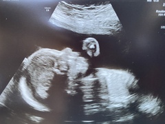 Pregnancy after loss - Autumn Babies 2021 - Thread 3