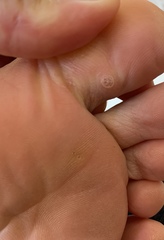 What is this on my foot? (Trigger warning, not the nicest picture of a possible bite on my big toe!)