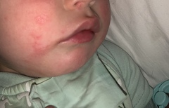 Toddler & constant cheek rash