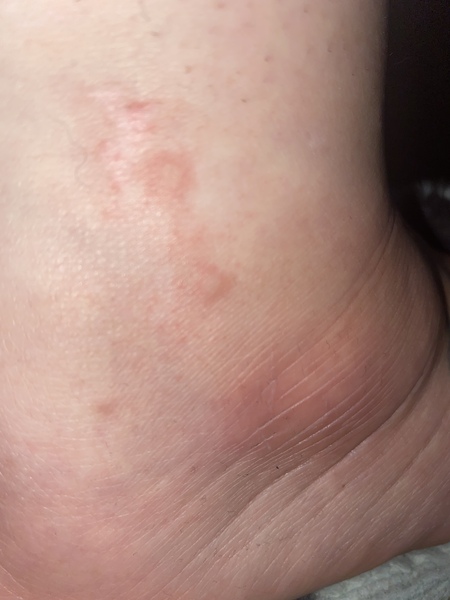 Is this psoriasis or eczema?