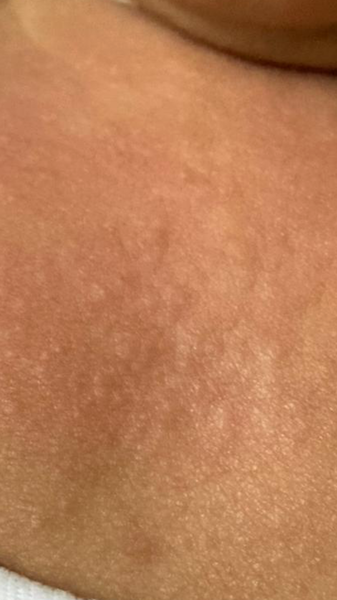 Baby broke out in a really bad rash