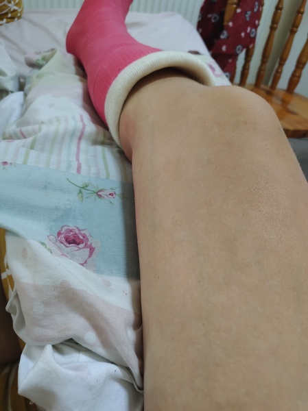 Diet & broken limbs/limited mobility (Terrified of weight gain)