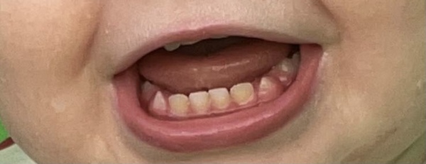 Any dentists about? AIBU to be worried about 18 month old’s yellow teeth?