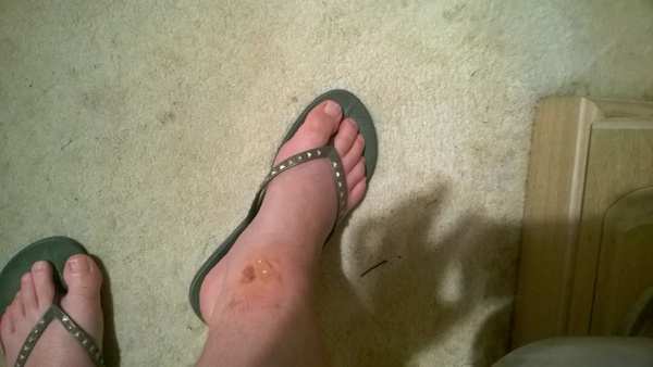 Wise Mumsnetters, what should I do? (Gross picture included.)