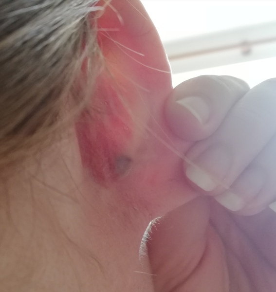 Where can I get a large blackhead removed in London?