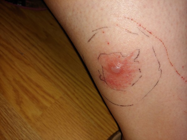 To pester the GP for this horse fly (I think) bite?