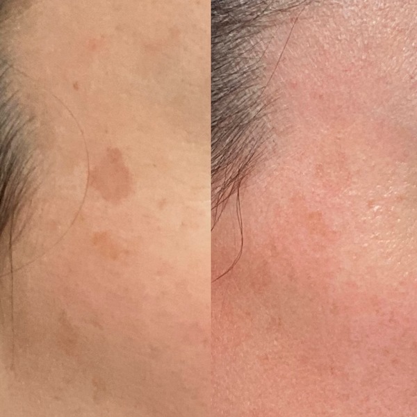 Has anyone got rid of dark spots on the face?