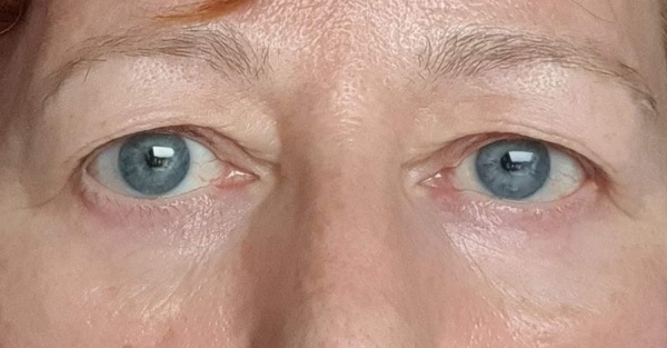 I look so old! What to do about my eyes?