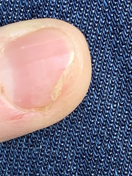 Fingernail - not sore or gloopy, just weird.
