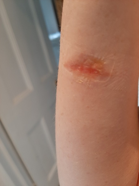 Anyone know about burns? Pic warning...