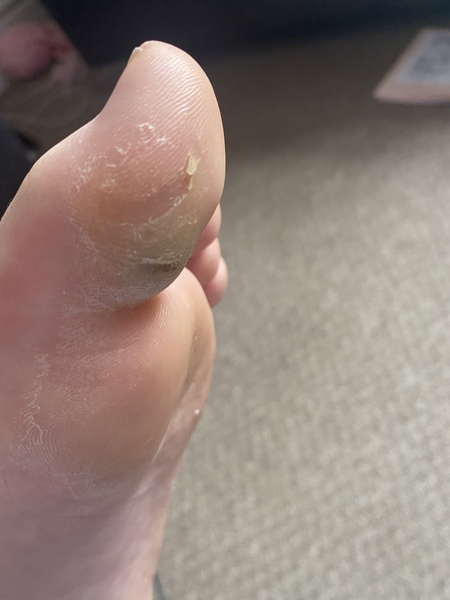 DD’s toe abscess