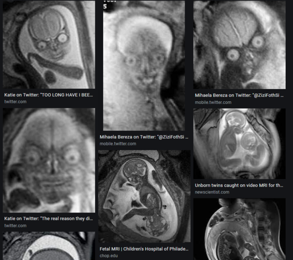 How have I only just found out that babies are born with no knee caps!