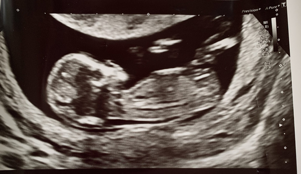 Another one! Boy or girl, any guesses? 13 weeks