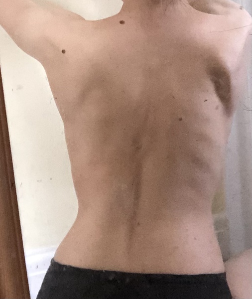 To think I might have lipedema? Anyone know anything about it?