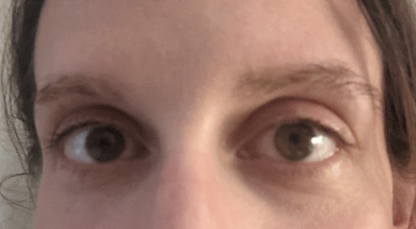I look so old! What to do about my eyes?