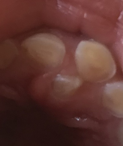 Worried about my 7 year olds son’s teeth.