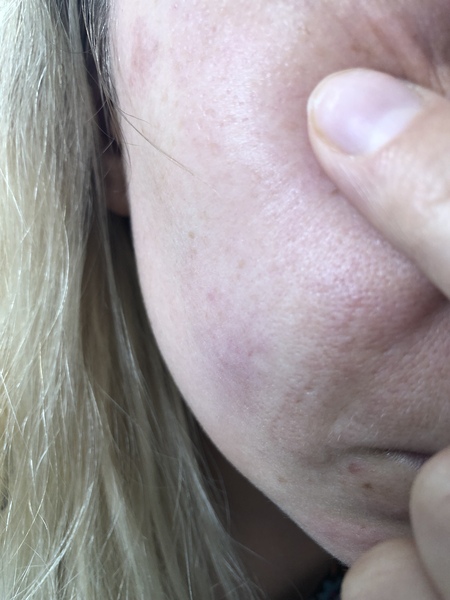 Has anyone been left with scarring after plasma pen/fibroblast?