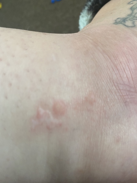 Is this psoriasis or eczema?