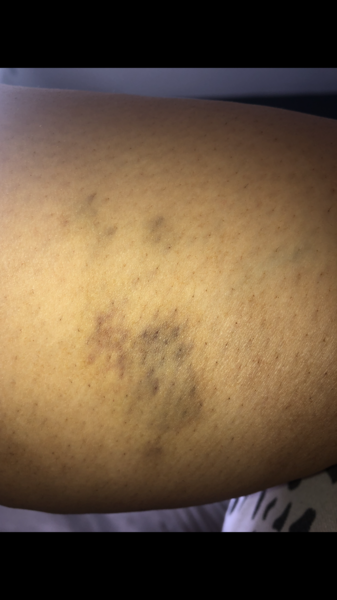 PGP/ cramp in legs so bad it’s bruising me