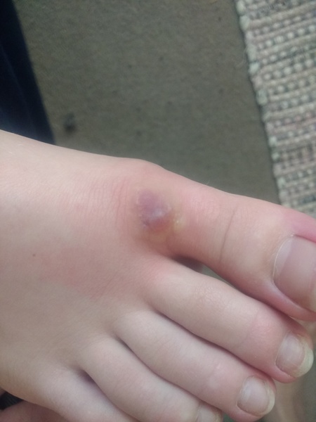 Insect bites (pictures) - anyone an expert on reactions to these?