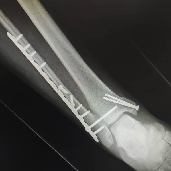 Diet & broken limbs/limited mobility (Terrified of weight gain)