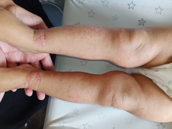 Do the spots for chickenpox look different to hand foot and mouth?